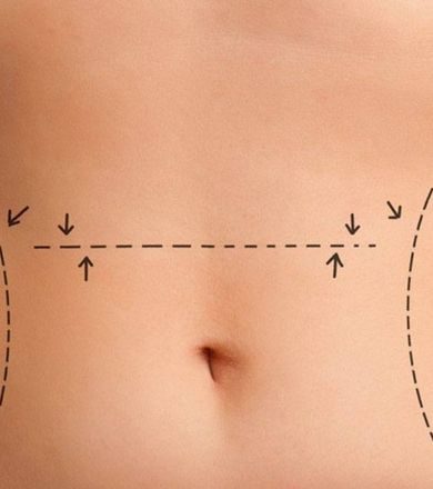 lipoescultura
